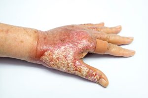 scaled hand