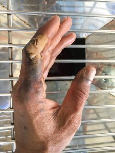 hand electrical burn