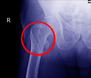 hip fracture